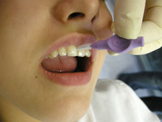 Reinigung der Zahnzwischenr&auml;ume mit Intradentalb&uuml;rstchen - Professionelle Zahnreinigung