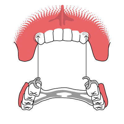 klammerprothese Veranschaulichung der Funktionsweise einer Klammerprothese als Teilprothese